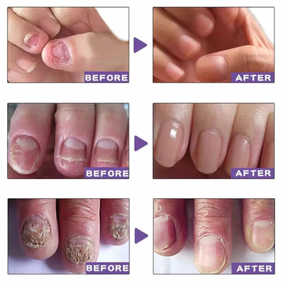 Fungal Nail Treatment Repair Serum