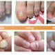 Fungal Nail Treatment Repair Serum