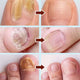 Fungal Nail Treatment Repair Serum